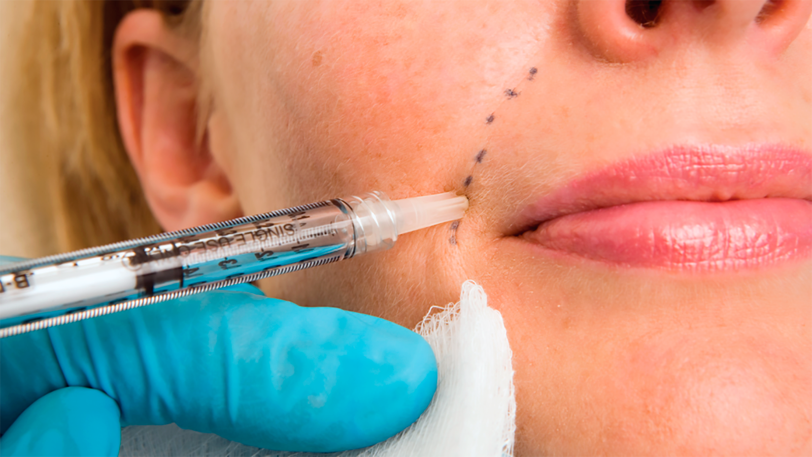 Dermal filler facial contour planning